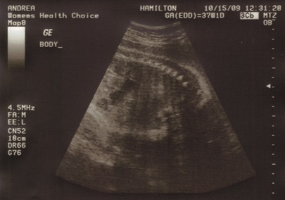 2nd Ultrasound Body