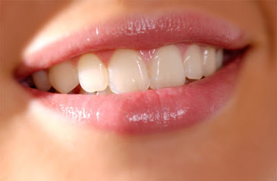 Làm răng sứ veneer trong trường hợp nào?