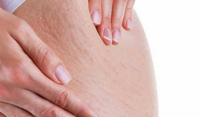 How To Quickly And Naturally Eliminate Cellulite