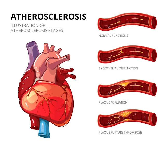 What are 6 symptoms of atherosclerosis,Can you reduce atherosclerosis