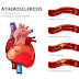 Arteriosclerosis: Symptoms, Causes & Treatment 