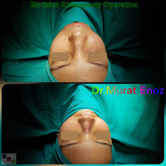 Revision Rhinoplasty Operation in Istanbul, Ethnic Revision Nose Job Turkey