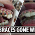 A Woman Whose DIY Dental Braces Terribly Gone Wrong 