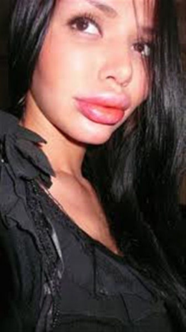 Dunia Dalam Gambar Mega Lips Bibir Dower Bibir Monyong