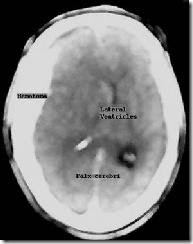 Intracranial hemorrhage (ICH)