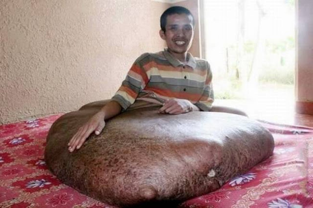 80 Kilogram Tumor