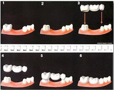 Hỏi cầu răng sứ là gì và giải đáp của bác sĩ-2
