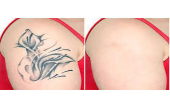 Tattoo Removal Centre At Navi Mumbai