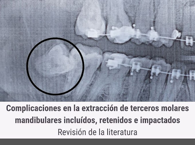 PDF: Complicaciones en la extracción de terceros molares mandibulares incluídos, retenidos e impactados. Revisión de la literatura