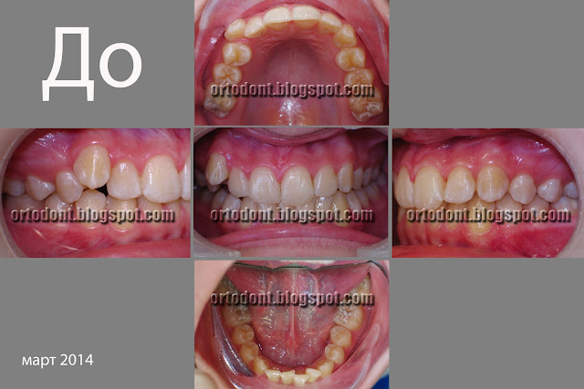 На фотографии изображен случай скученного положения зубов, требуемый ортодонтического лечения.