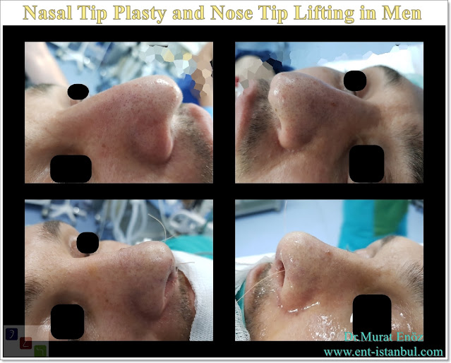 Droopy nose tip - Nasal tip plasty in men istanbul