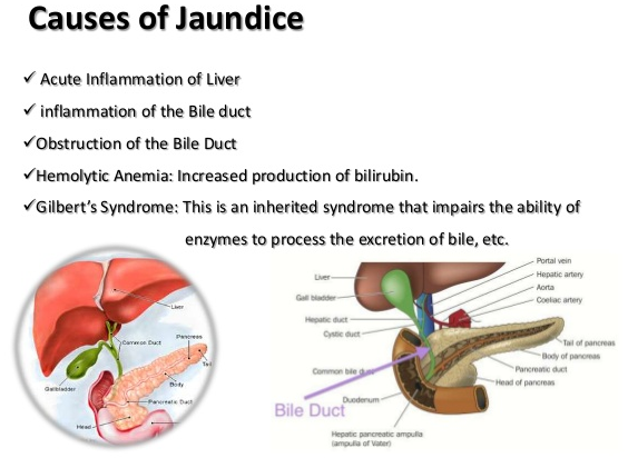 Causes and Symptoms of Jaundice