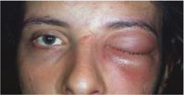 male with orbital cellulitis with proptosis, ophthalmoplegia, and ...