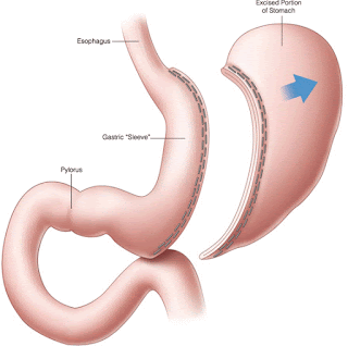 weight-loss-surgery