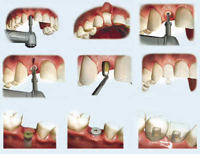 Trồng răng bằng phương pháp cấy ghép implant
