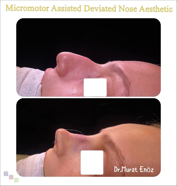 micromotor assisted deviated nose aesthetics, micromotor rhinoplasty, deviated nose correction, nasal deviation surgery, micromotor osteotomy, crooked nose surgery, advanced rhinoplasty techniques, nasal aesthetics, micromotor nose surgery, micromotor rhinoplasty recovery, precision rhinoplasty, deviated septum correction, functional rhinoplasty, breathing improvement surgery, minimally invasive rhinoplasty