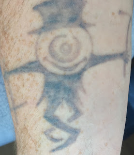Tattoo fading after Picosure