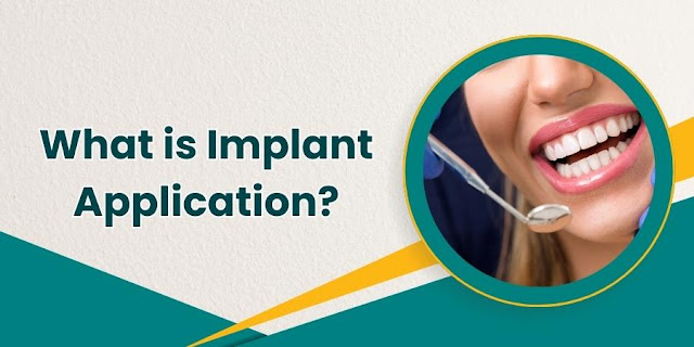 What is Implant Application