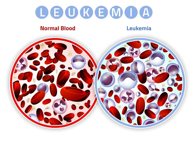 Penyakit Leukimia adalah? Simak Penjelasannya