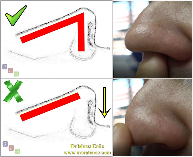 Deviasyon ameliyatı sonrası burun ucu düşmesi - Burun ameliyatı sonrası burun ucu düşmesi - Burun ucu neden düşer? - Nazal tip pitozis - Nazal tip pitozis - Burun ucu düşüklüğü - Burun ucu sarkması