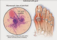 Cara Cepat Menyembuhkan Asam Urat