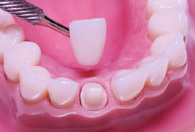 Làm răng sứ thẩm mỹ là gì?