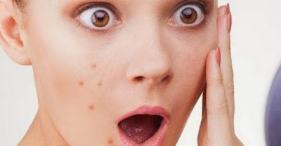 Natural Ways to Remove Black Spots On Skin
