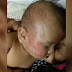 Bayi 3 bulan cedera, kepala ditimpa buah durian