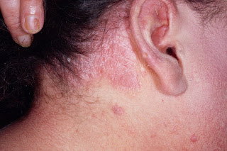 Pin Mild Plaque Psoriasis On Scalp On Pinterest