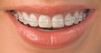 Niềng răng là cách chữa răng bị vẩu hiệu quả nhất hiện nay