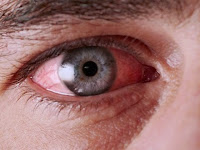 Cara Menghilangkan Mata Gatal Dan Merah