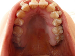 A photograph of teeth with fixed ceramic braces at week 17 of treatment