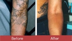 Laser Tattoo Removal - How Effective Will it Be?