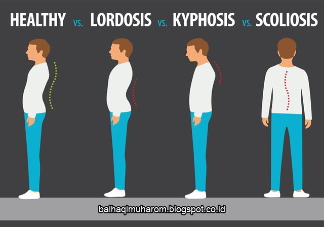 Apa Itu Kelainan Tulang Kifosis Skiliosis dan Lordosis ? - Baihaqi