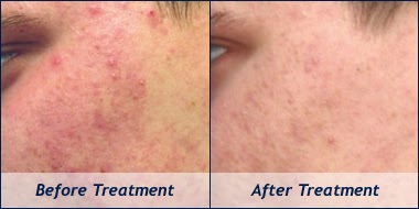 http://beautyandhealthtipstricks.blogspot.com/2014/07/acne-treatment-acne-pimples-and-its.html