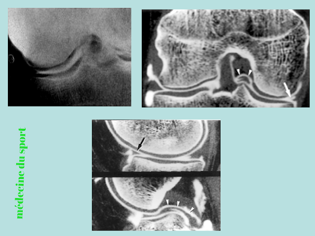 IMAGERIE DU GENOU APPLIQUÉE A LA PATHOLOGIE SPORTIVE