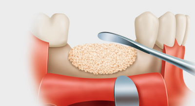 Xuất hiện màng trắng sau khi nhổ răng dự báo điều gì?-1