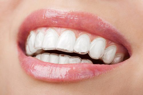 Niềng răng Invisalign đảm bảo giá trị thẩm mỹ cao