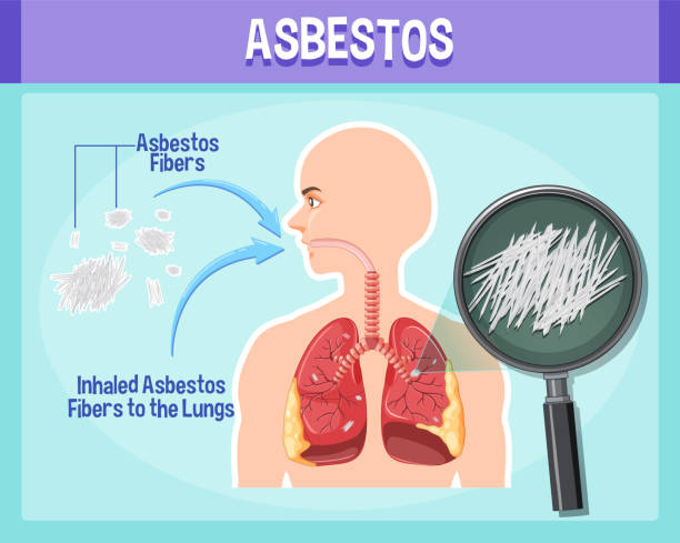 The Truth About Mesothelioma Life Expectancy