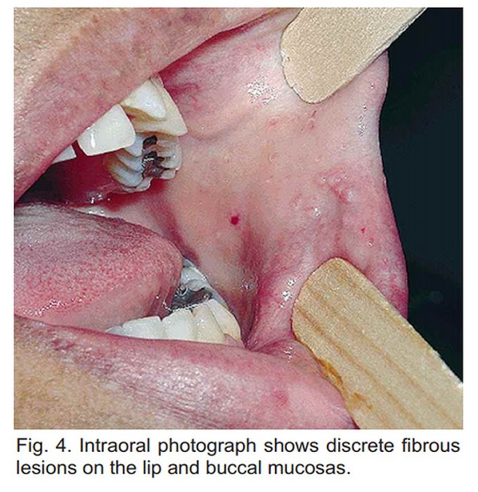 PDF: TUBEROUS SCLEROSIS - A Case Report with Oral Manifestation