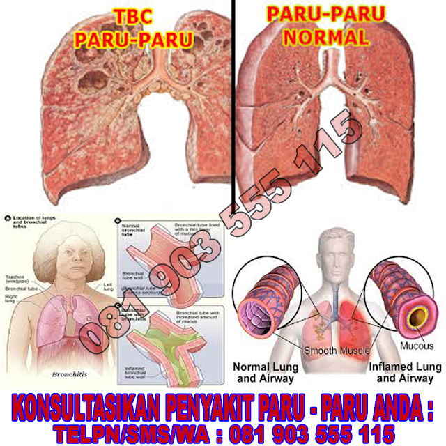 inilah ramuan tanaman obat untuk paru paru yang sudah terbukti ampuh - inilah obat paru paru serta batuk berdarah di apotik, 9 nama obat detopar dan pipeca untuk penyakit paru paru ampuh, jenis pil obat paru paru basah herbal di apotik, inilah ramuan tanaman obat untuk paru paru yang terbukti ampuh, 20 resep obat tradisional paru basah dan kering, kumpulan obat antibiotik untuk paru paru manjur di apotik, 5 gambar obat paru paru yang familier di masyarakat