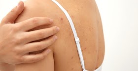 How to Get Rid of Back acne and Back acne Scars with natural treatment