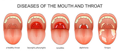 Tonsillitis