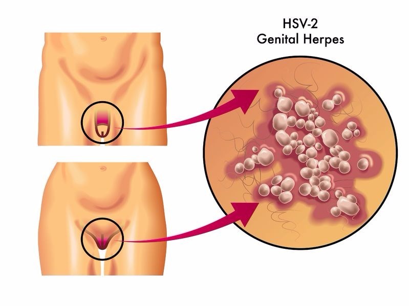 hsv 2 herpes genital