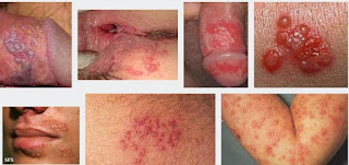 Berapa Harga Obat Herpes Gangjie Ghosiah Di Semarang Ungaran