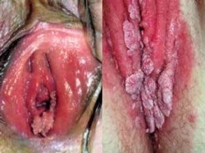 obat tradisional kutil kelamin di vagina