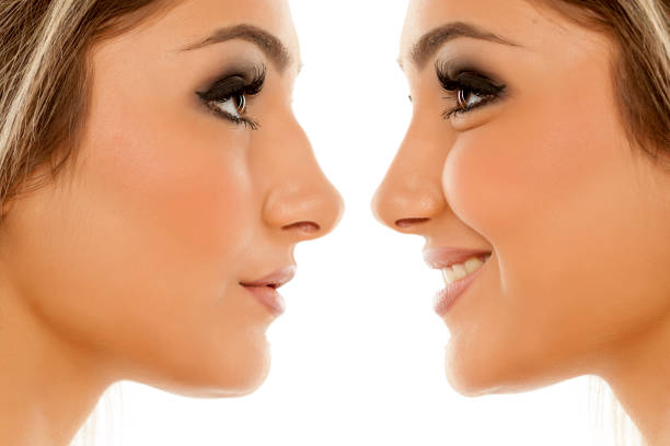 New York City Rhinoplasty - Dr. Jennifer Levine