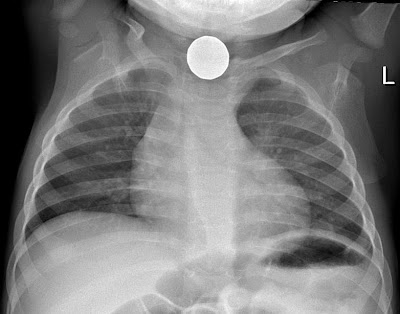 PA view Chest X-Ray of