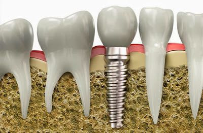 Cách chăm sóc sau khi cấy ghép implant