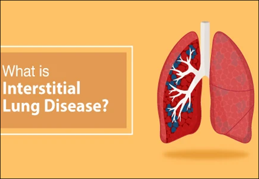 Interstitial Lung Disease, Herbal Remedies for Interstitial Lung Disease, ILD, Ayurvedic Treatment, Causes, Supplements, ILD Ayurvedic Treatment